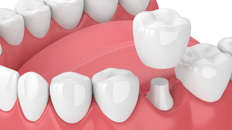 Bọc sứ cho răng mọc lệch như thế nào? Chi phí ra sao? 4