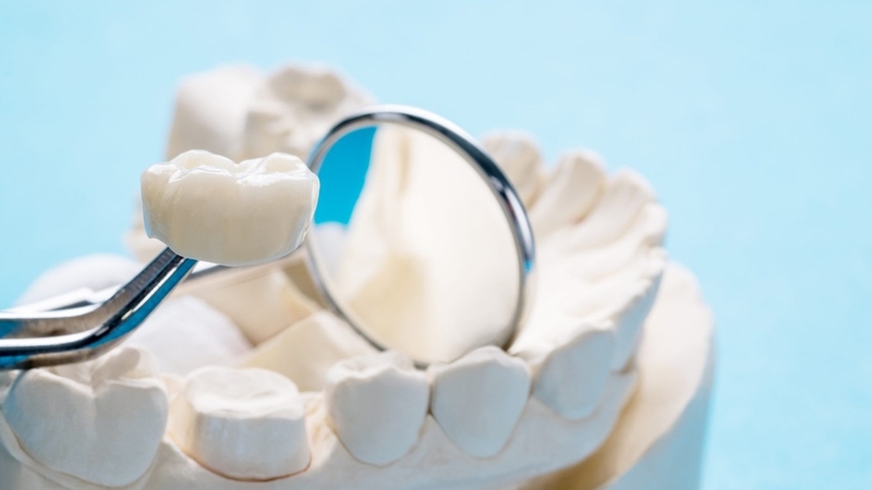 Bọc sứ răng cấm: Tác dụng, quy trình và cách chăm sóc 3