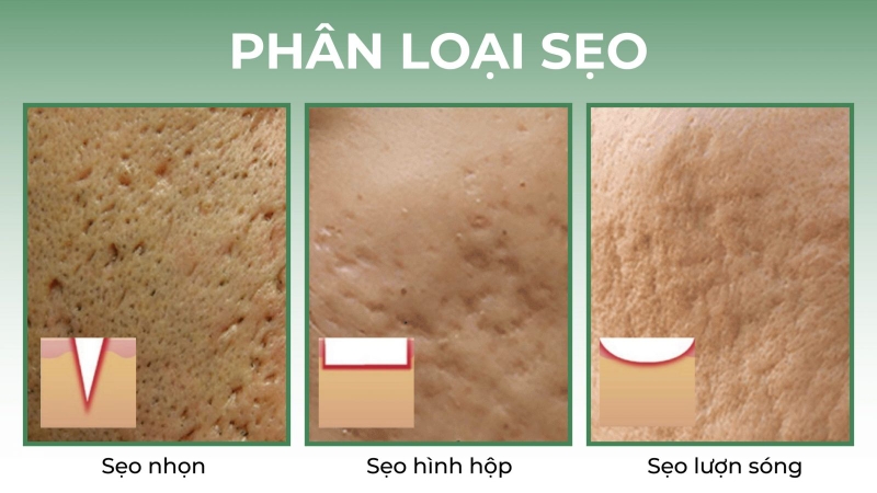 Bóc tách sẹo - Hành trình tìm lại làn da mịn màng! 1