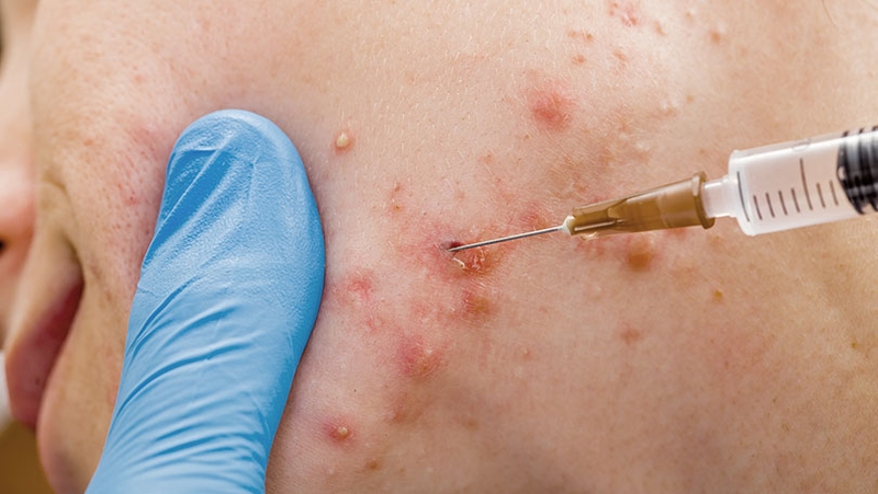 Bóc tách sẹo - Hành trình tìm lại làn da mịn màng! 3