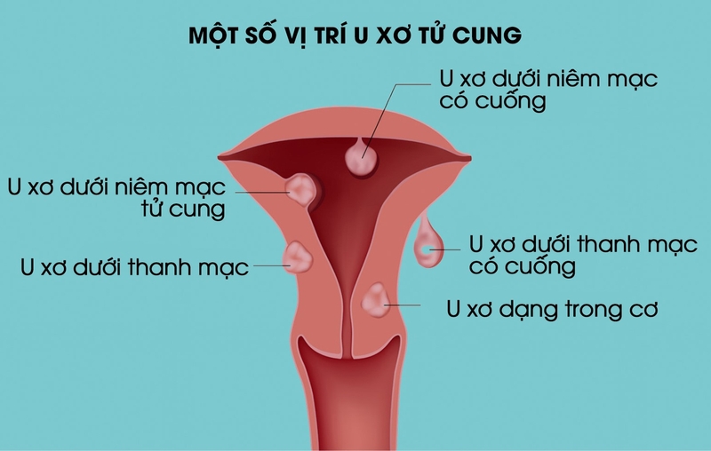 Bóc u xơ tử cung có mất máu nhiều không 1