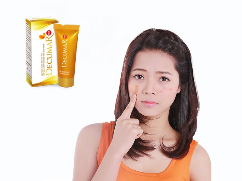 Kem trị mụn Decumar là một trong những phương pháp điều trị mụn phổ biến nhất hiện nay