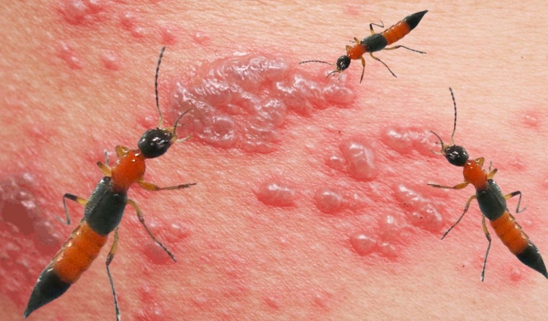 Bôi hồ nước khi bị kiến ba khoang đốt như thế nào? Các loại thuốc bôi trị kiến cắn 1