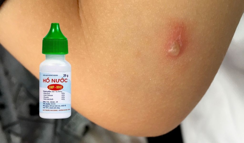 Bôi hồ nước khi bị kiến ba khoang đốt như thế nào? Các loại thuốc bôi trị kiến cắn 2