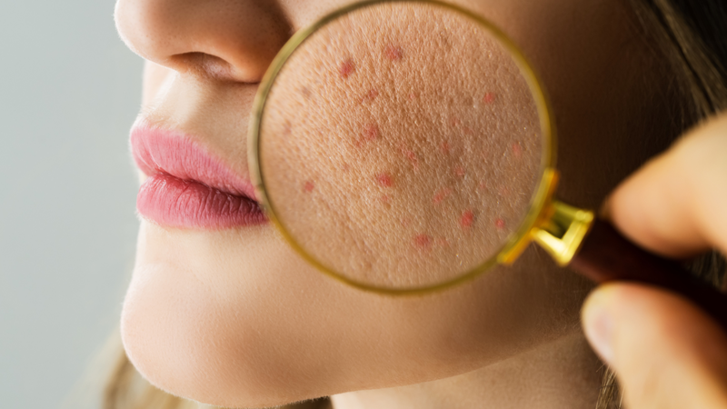 Dấu hiệu của việc dưỡng ẩm quá mức