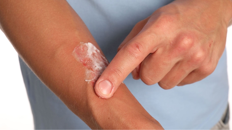 Bôi kem trị sẹo bao lâu thì khỏi? Phụ thuộc vào nhiều yếu tố khác nhau