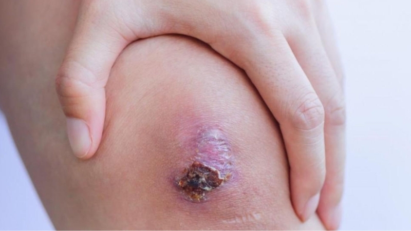 Nên bôi kem sẹo trong giai đoạn tái tạo da