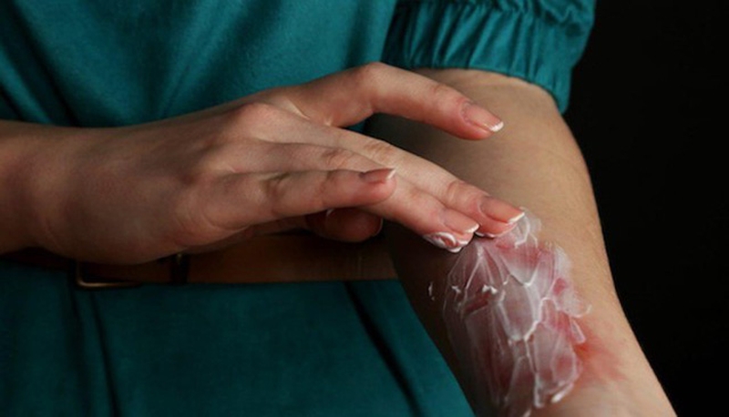 Hướng dẫn sơ cứu bỏng đúng cách theo từng mức độ 3