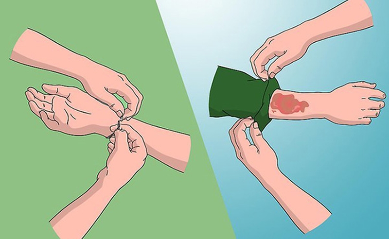 Cách sơ cứu khi bị bỏng lửa đúng khoa học giúp giảm biến chứng 1