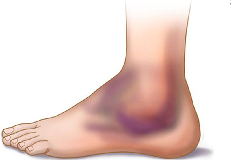 Bong gân cổ chân cấp độ 1 và những điều bạn nên biết 2