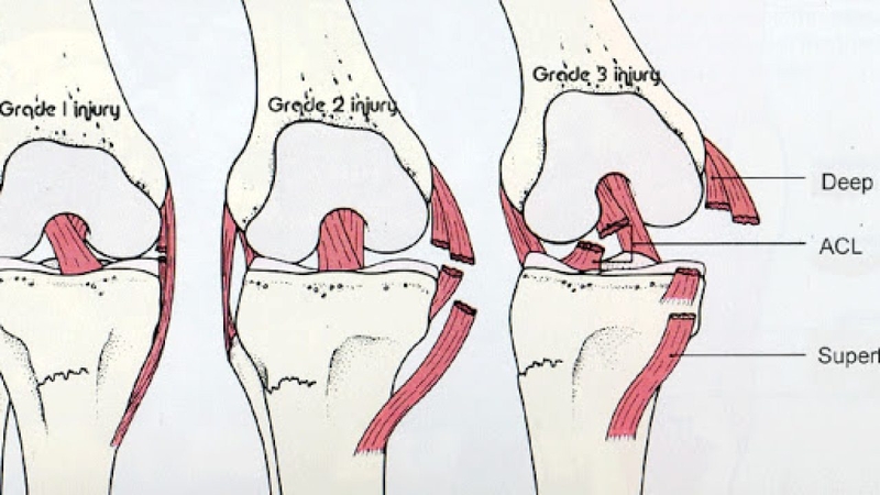 Bong gân đầu gối là tình trạng dây chằng bị rách hoặc giãn quá căng giữa các mô giữ xương với nhau