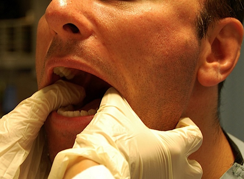 Bong gân hàm có phải sái quai hàm hay không? 3