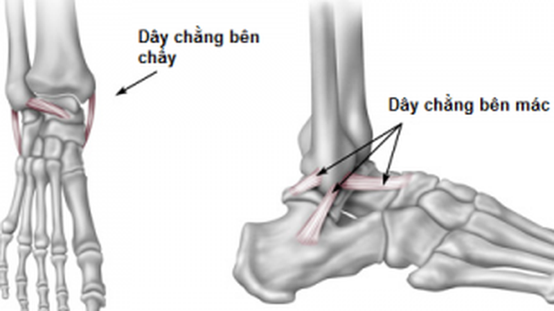 Bong gân mãn tính là gì? Biểu hiện? Có ảnh hưởng nghiêm trọng không? 1