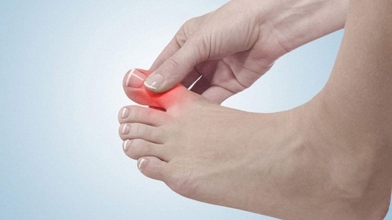 Bong gân ngón chân xảy ra khi các dây chằng bị tổn thương do giãn quá mức, thậm chí là bị rách