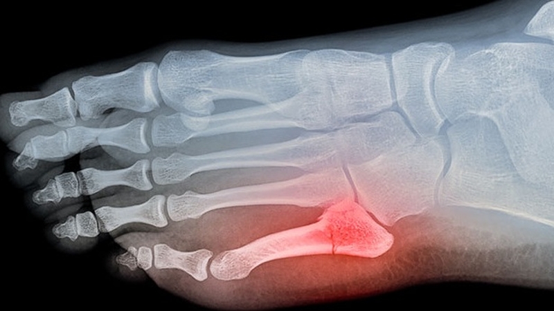 Bong gân ngón chân út: Biểu hiện, phương pháp điều trị mau khỏi nhất 1