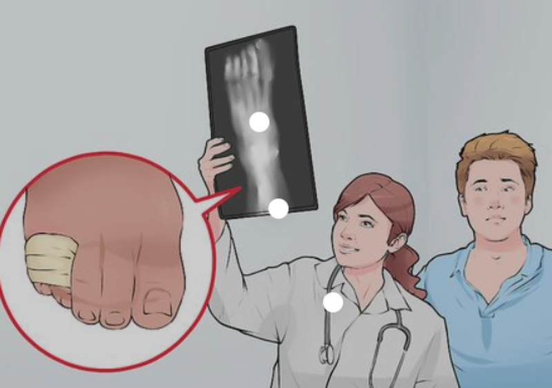 Bong gân ngón chân út: Biểu hiện, phương pháp điều trị mau khỏi nhất 3