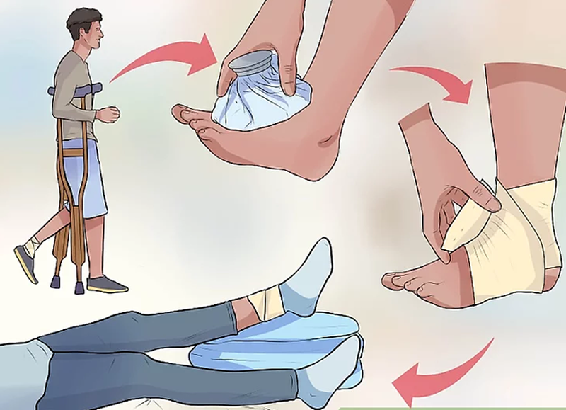 Bong gân sưng bao lâu? Bong gân cổ tay mất bao lâu để hồi phục trở lại? 1