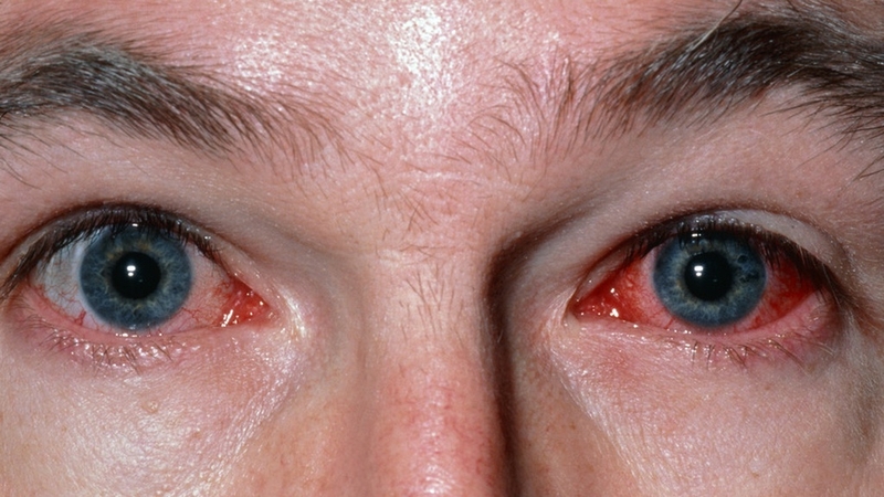 Bỏng giác mạc: Nguyên nhân, biến chứng và cách xử trí 2