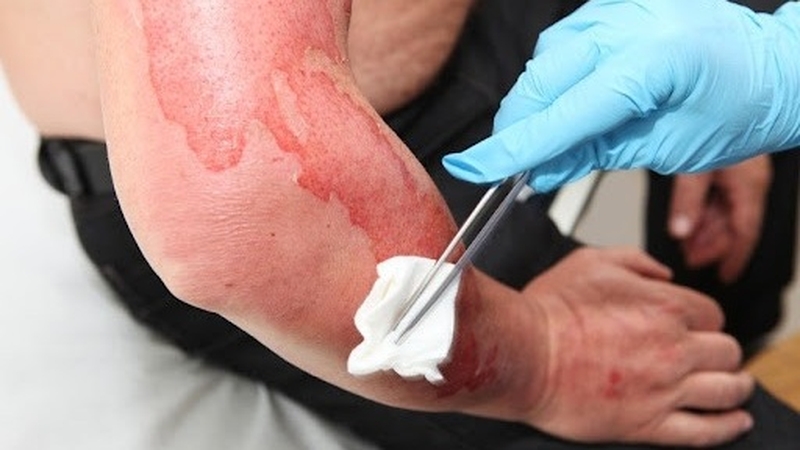 Bỏng hàn và cách sơ cứu và điều trị hiệu quả 3