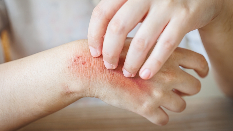 Bỏng hóa chất là tình trạng gì? Bị bỏng hóa chất phải làm sao? 2