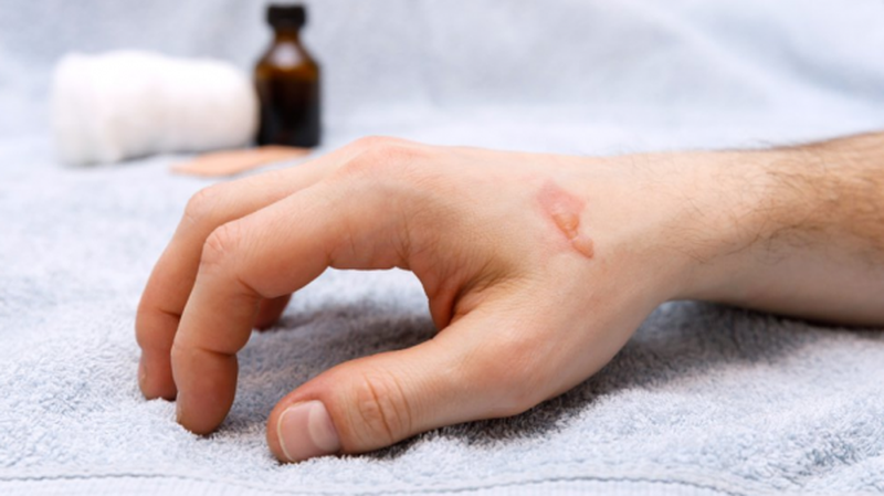 Bỏng keo nến - những cách xử trí đơn giản và hiệu quả 2