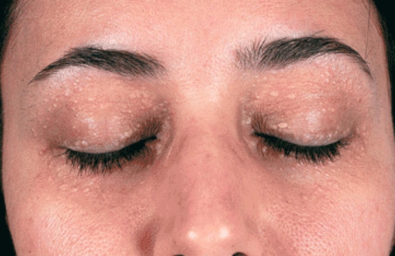 Bọng mắt xuất hiện mụn thịt phải làm sao 1