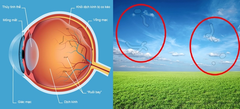 Bong võng mạc có chữa được không? Điều trị như thế nào?  2