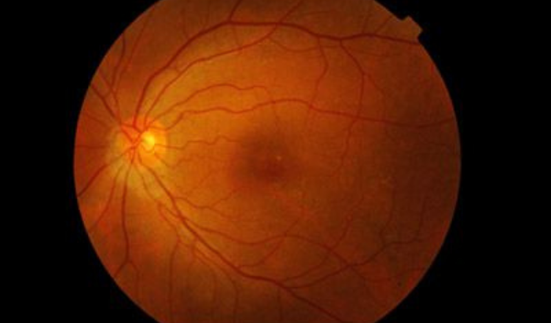 bong võng mạc thanh dịch là gì?