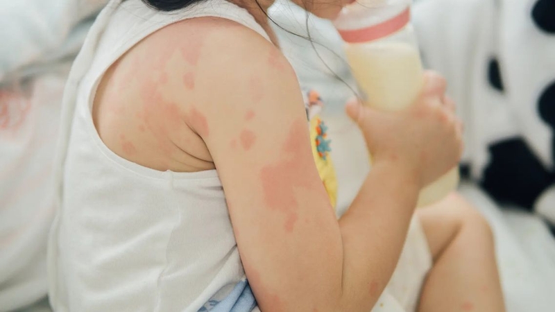 Dị ứng đạm sữa bò có thể gây ra nhiều triệu chứng khác nhau ở trẻ nhỏ