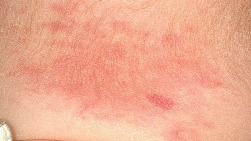 Bớt cá hồi thường có màu hồng cam hoặc đỏ nhạt