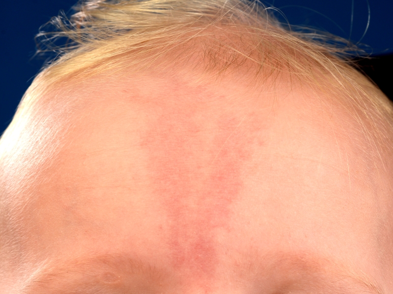 Cũng giống các loại bớt khác, bớt cá hồi không lây lan