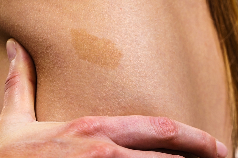 Bớt cà phê sữa là gì? Nguyên nhân và cách điều trị bớt cà phê sữa 2