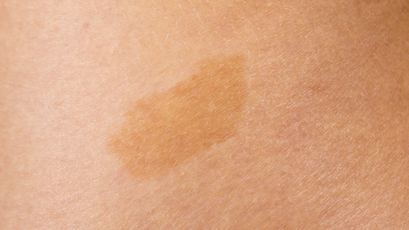 Bớt cà phê sữa là gì? Nguyên nhân và cách điều trị bớt cà phê sữa 1