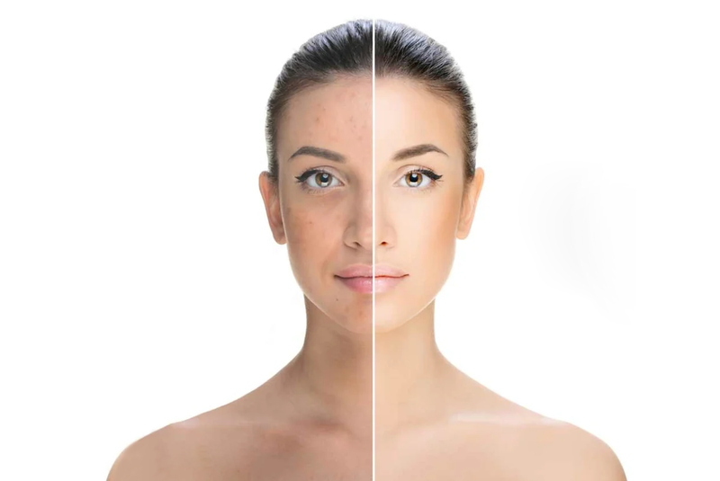 Bột cam thảo trị nám hiệu quả không?