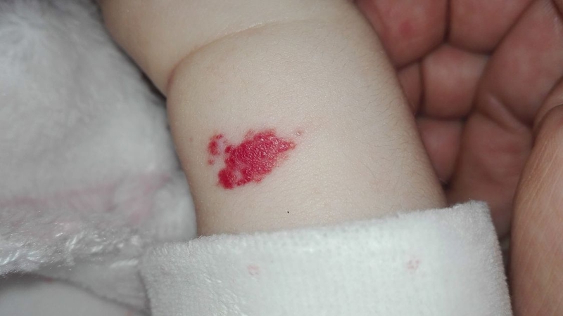 Bớt đỏ ở trẻ sơ sinh có hết không? Loại bớt nào có thể tự hết loại nào không 1