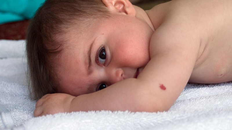 Bớt đỏ ở trẻ sơ sinh có hết không? Loại bớt nào có thể tự hết loại nào không 2