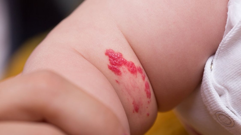 Bớt đỏ ở trẻ sơ sinh có hết không? Loại bớt nào có thể tự hết loại nào không 4