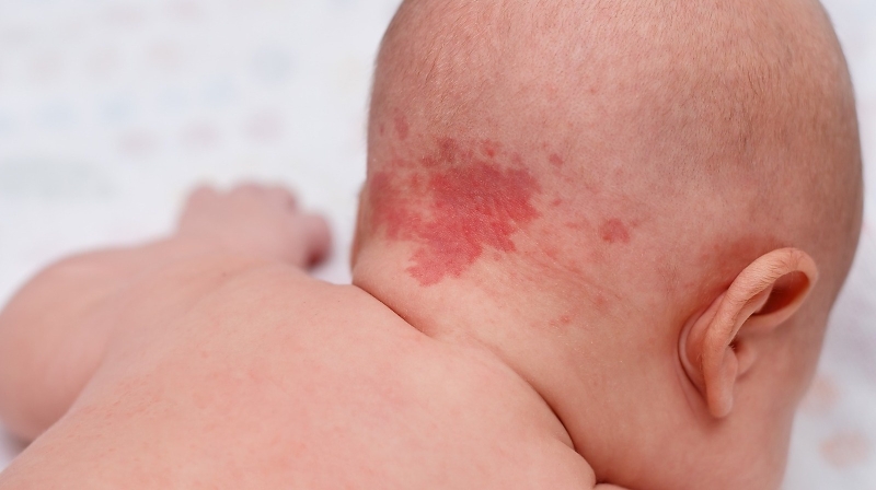 Phần lớn các vết bớt đỏ sau gáy đều vô hại đối với sức khỏe và không gây biến chứng