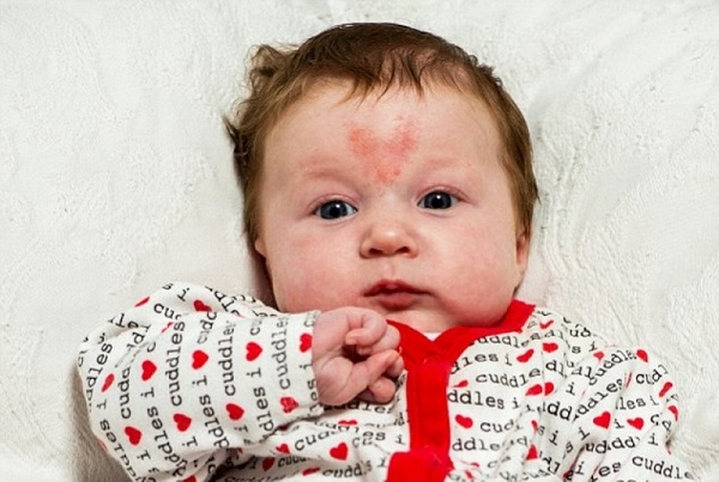 Các vết bớt ở trẻ sơ sinh thường gặp nhất và cách xử lý 3