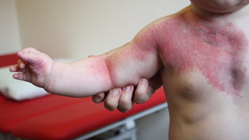 Bớt rượu vang: Cách phân biệt và điều trị hiệu quả 3