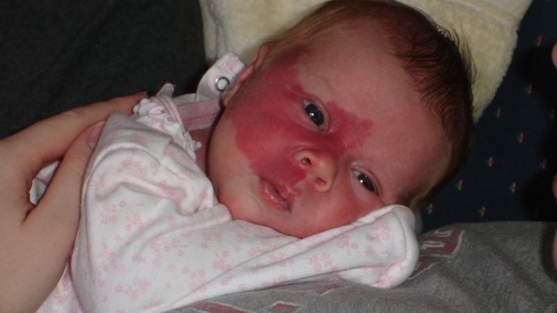 Bớt rượu vang: Cách phân biệt và điều trị hiệu quả 1