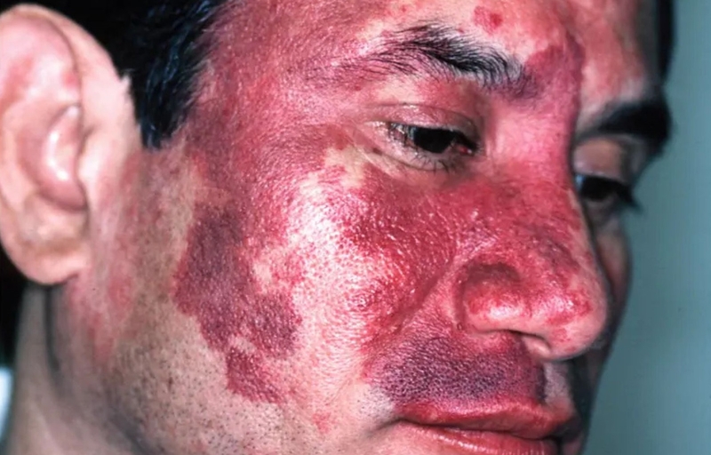 Bớt rượu vang: Cách phân biệt và điều trị hiệu quả 4