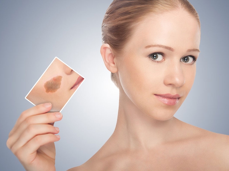 Có thể can thiệp thẩm mỹ để xóa, làm mờ vết bớt khi trưởng thành