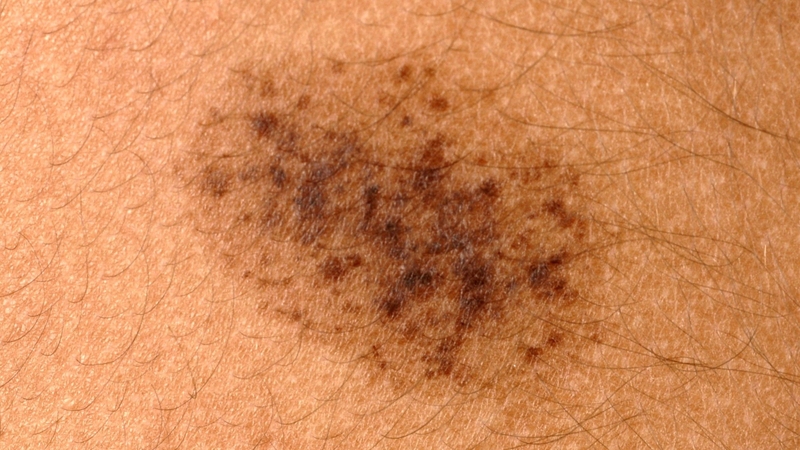 Bớt spilus là các vùng da tăng sắc tố bất thường