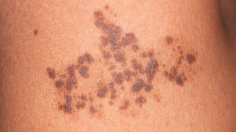 Nguyên nhân gây bệnh chưa xác định, đa số xuất hiện bẩm sinh