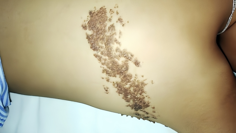 bot-sui-thuong-bi-nguyen-nhan-va-phuong-phap-dieu-tri