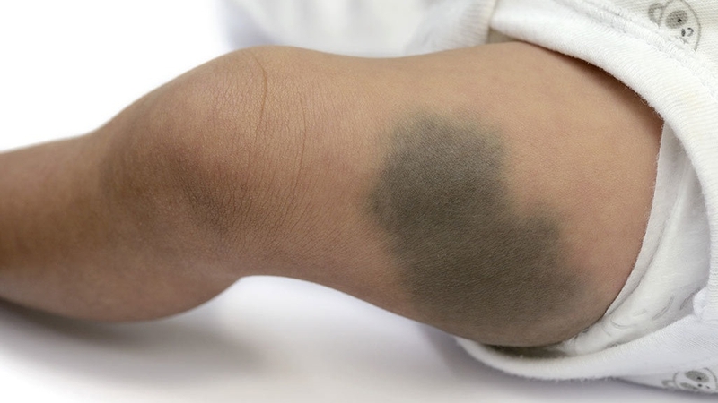 Vết bớt xanh còn gọi là bớt Mông Cổ