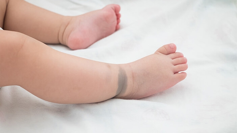 Thông thường vết bớt xanh không cần điều trị mà tự biến mất theo thời gian