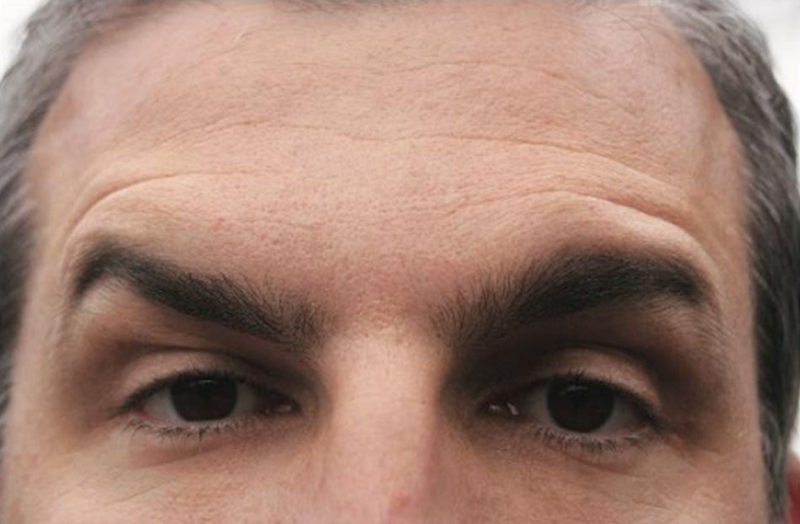 Vài nét chính về Botulinum toxin type A 4