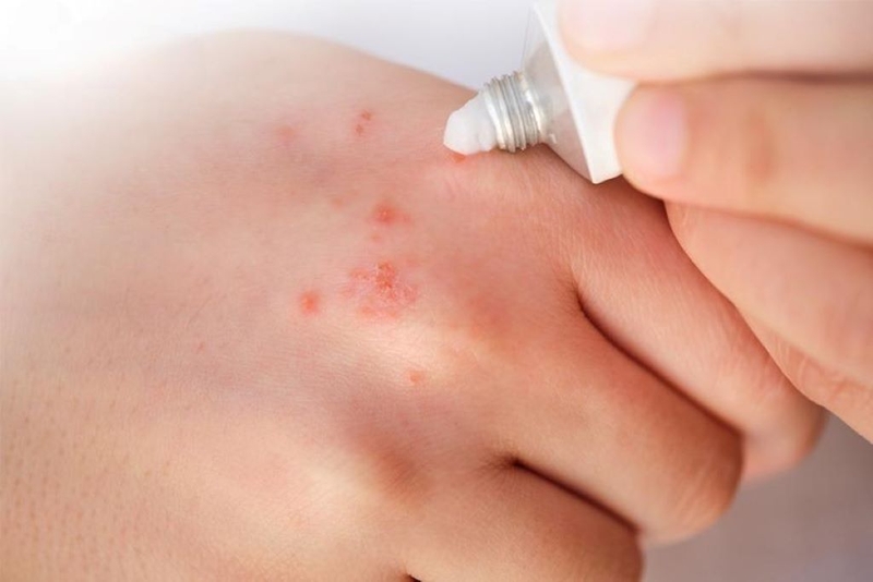 Bù mắt là con gì? Khi bị bù mắt cắn phải làm sao? 2